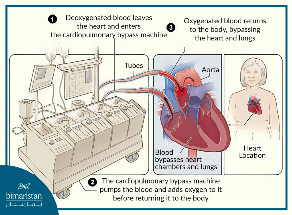 The Heart Pump Oxygenates The Blood And Pumps It Into The Body, Thus Performing The Function Of The Heart And Lungs.