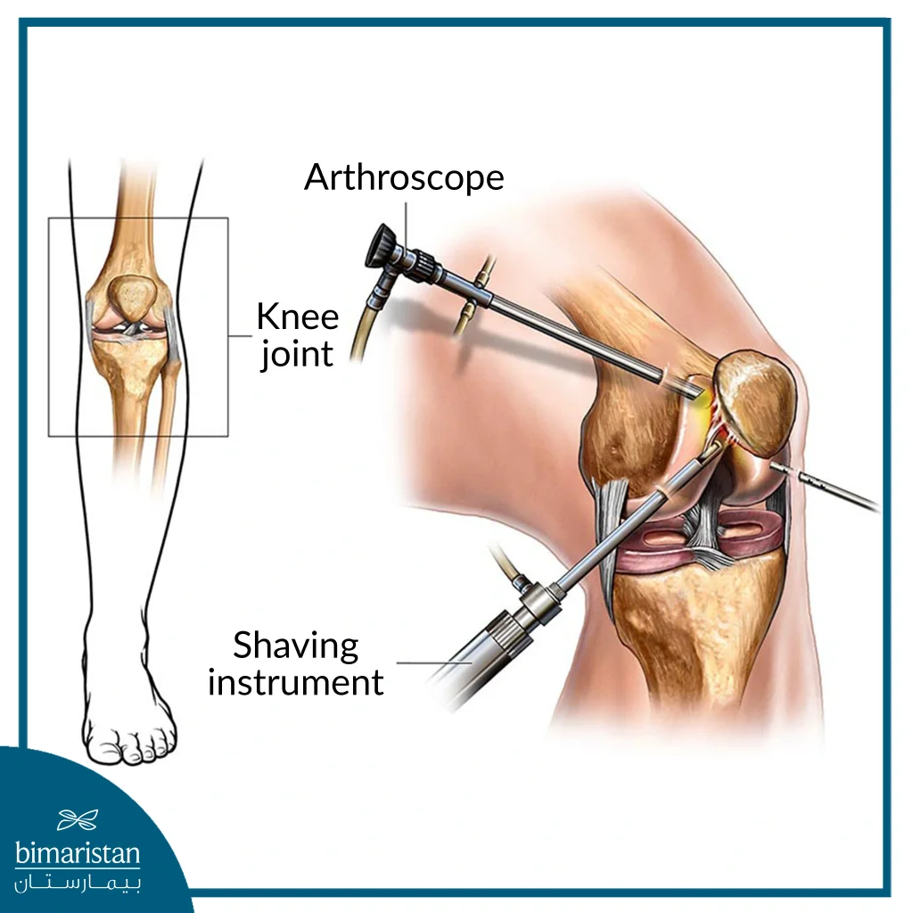 Image Showing The Method Of Performing Knee Cartilage Surgery Using Arthroscopy