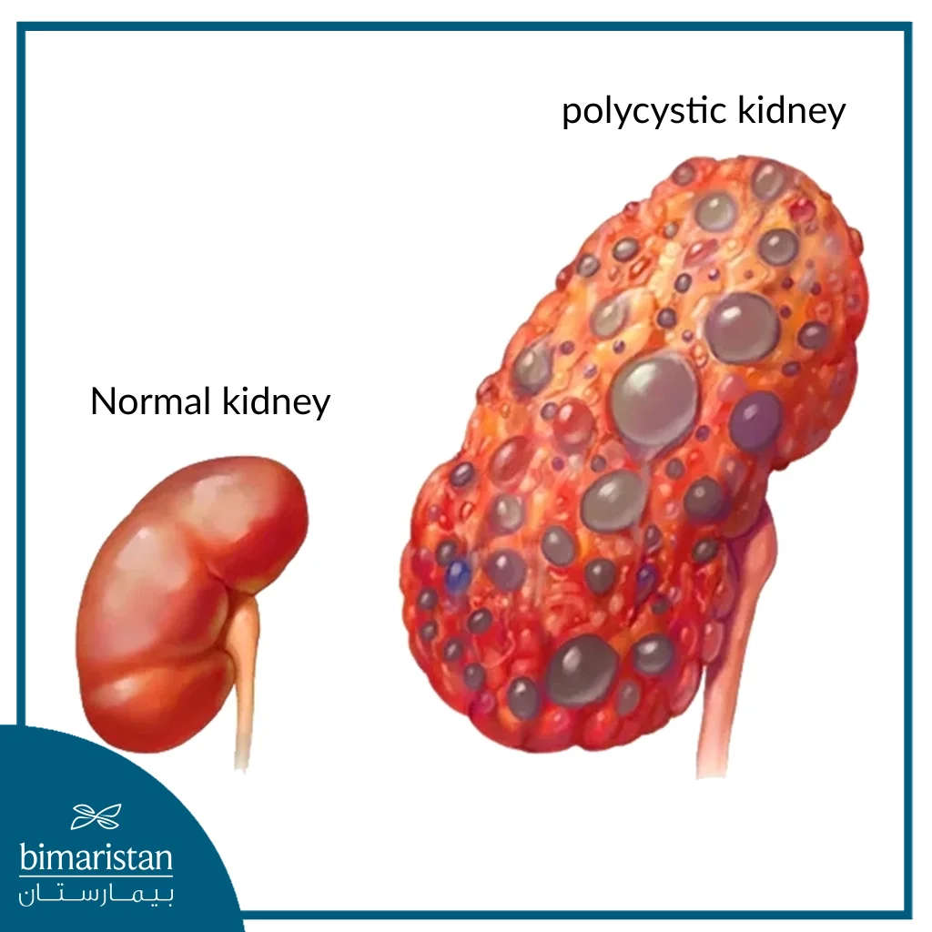 Image Talking About Polycystic Kidney That May Cause Early Kidney Failure Symptoms