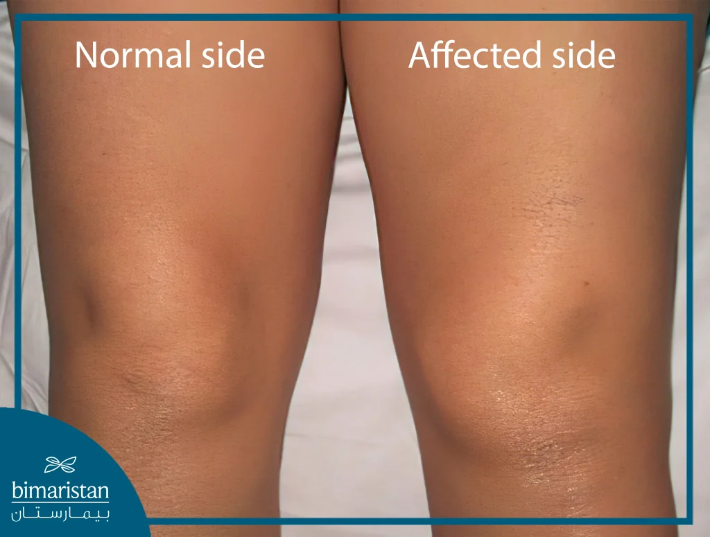 In This Image, We Observe A Comparison Between A Swollen Knee Joint And A Normal Knee.