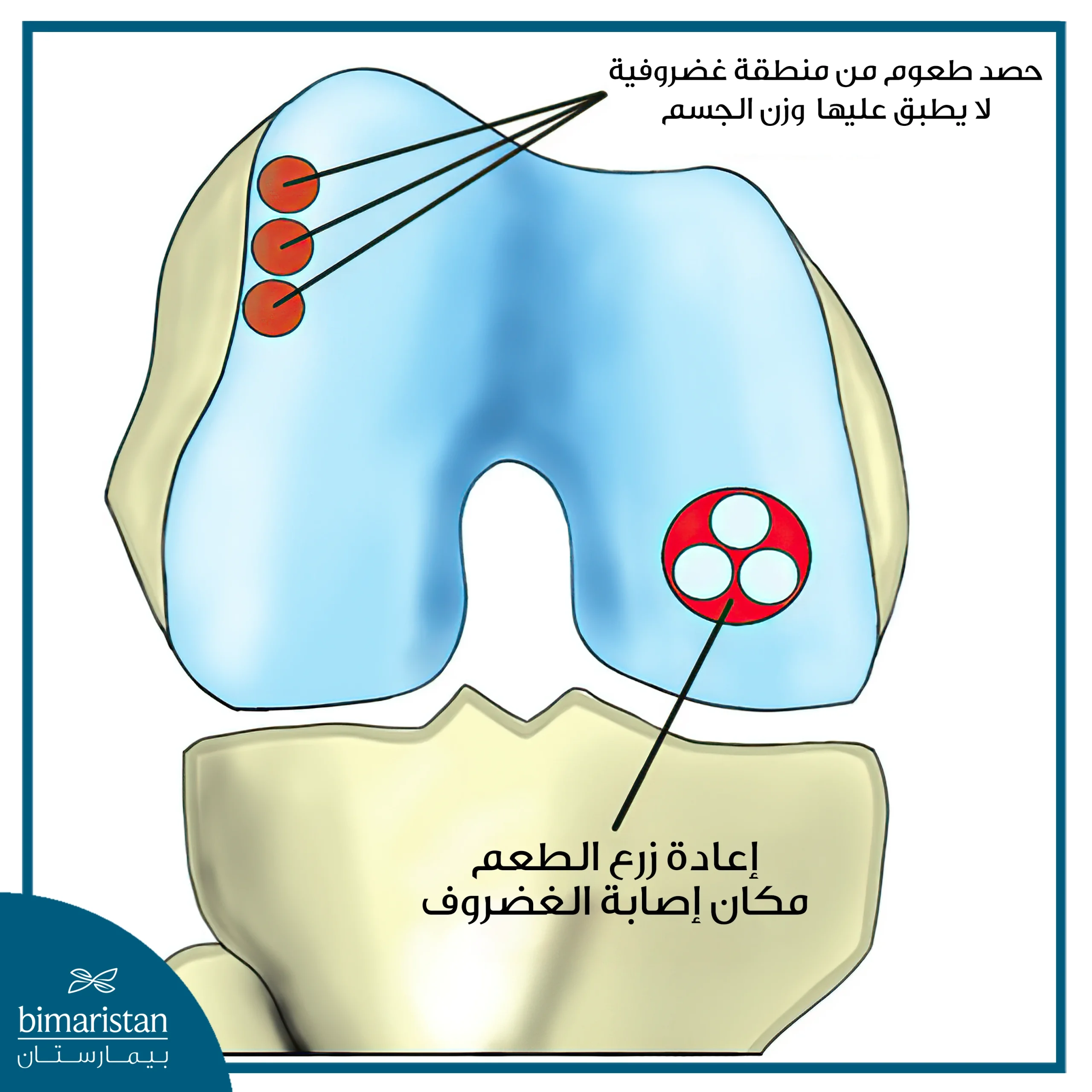 رسم يوضح عملية غضروف الركبة عن طريق استئصال طعوم ذاتية مأخوذة من جزء سليم من الغضروف وإعادة زرعها في مكان الإصابة