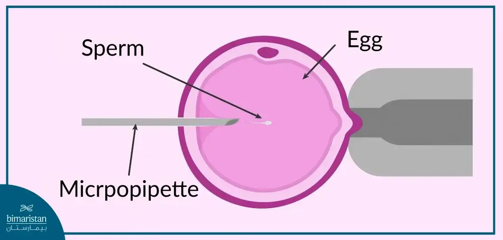 Intracytoplasmic Sperm Injection