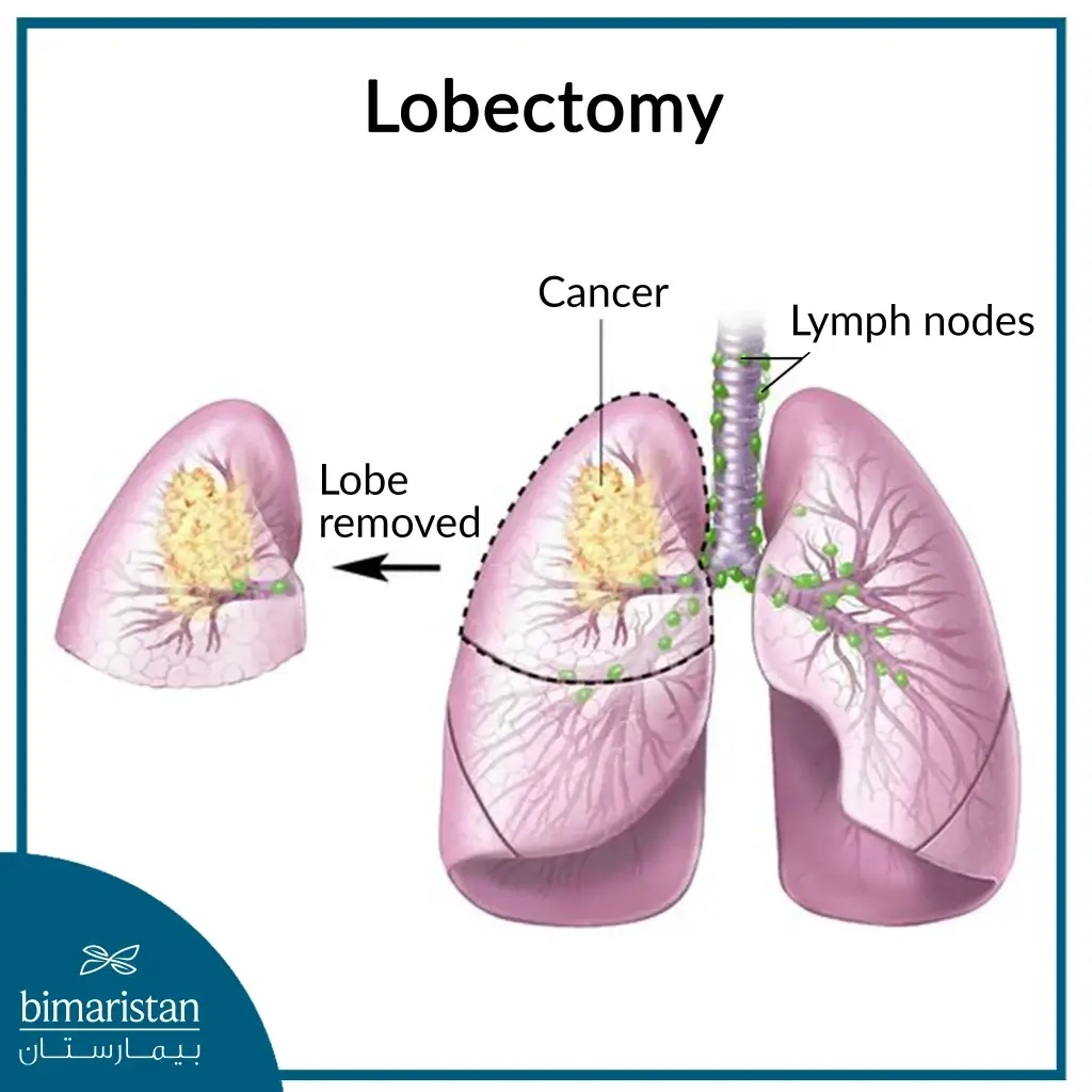 Lobectomy Is An Example Of Thoracic Surgery In Turkey 