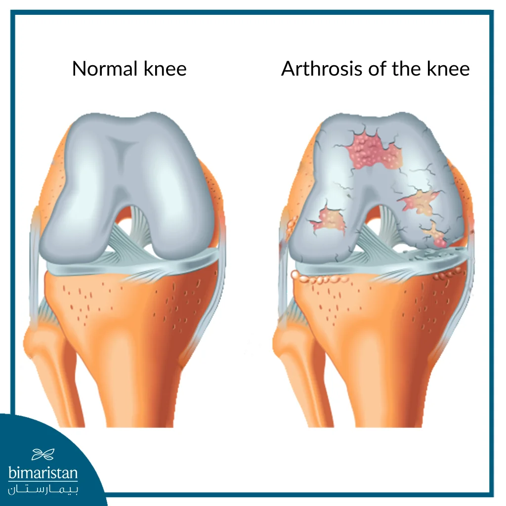 This Image Shows A Comparison Between Normal Knee Cartilage And Torn Cartilage That Requires Knee Cartilage Surgery For Repair