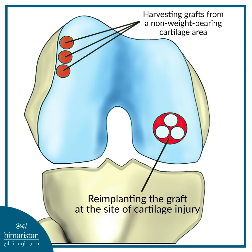 Diagram Illustrating Knee Cartilage Surgery By Harvesting Autografts From Healthy Cartilage And Reimplanting Them At The Injury Site