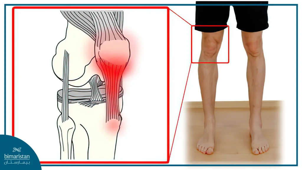 An Image Illustrating Patellar Tendonitis