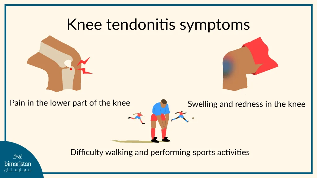 Knee Tendonitis Symptoms