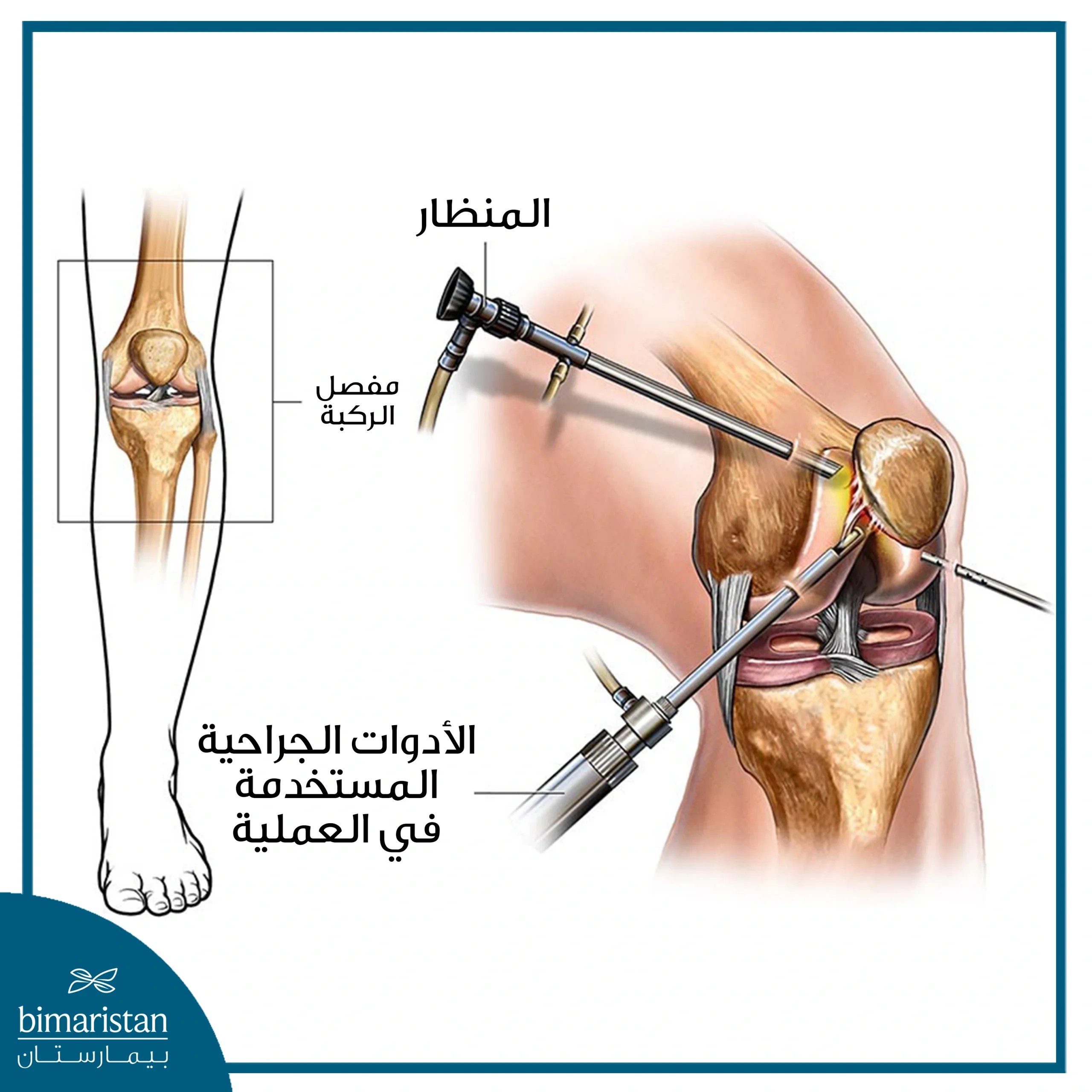 صورة تظهر طريقة إجراء عملية غضروف الركبة بالمنظار