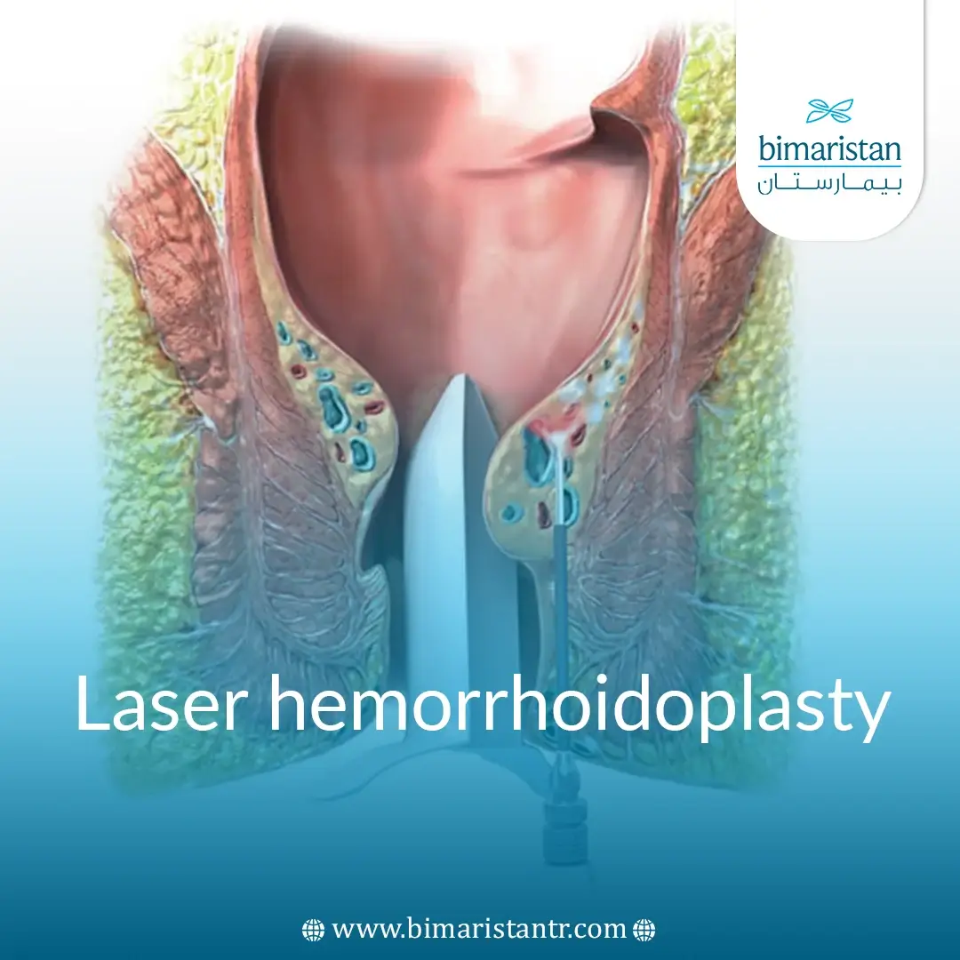 Laser Hemorrhoidoplasty