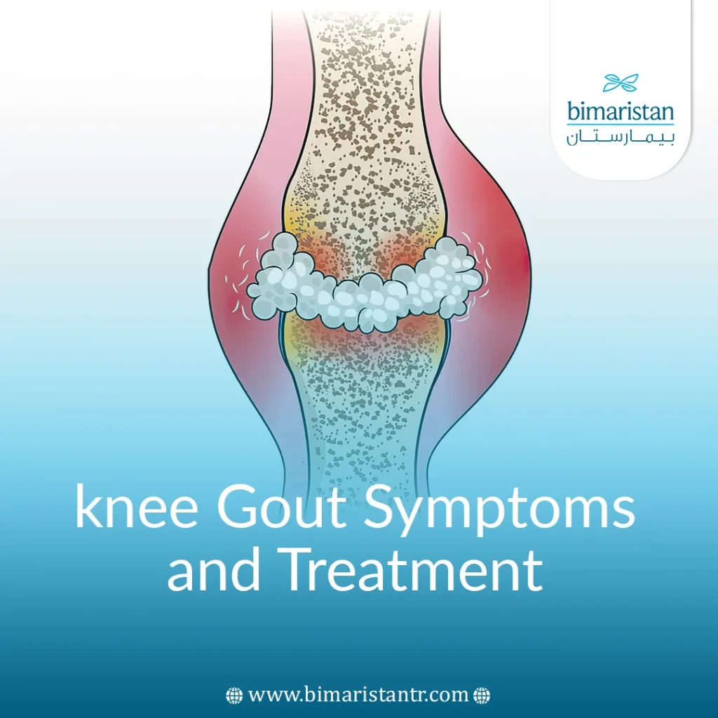 Knee Gout Symptoms