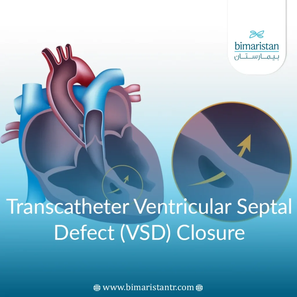 Transcatheter Ventricular Septal Defect Closure