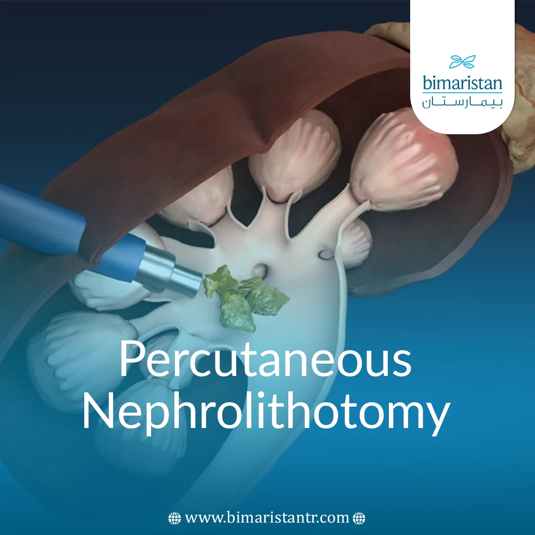 Percutaneous Nephrolithotomy