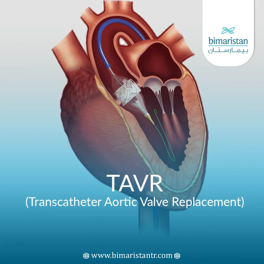 Tavr