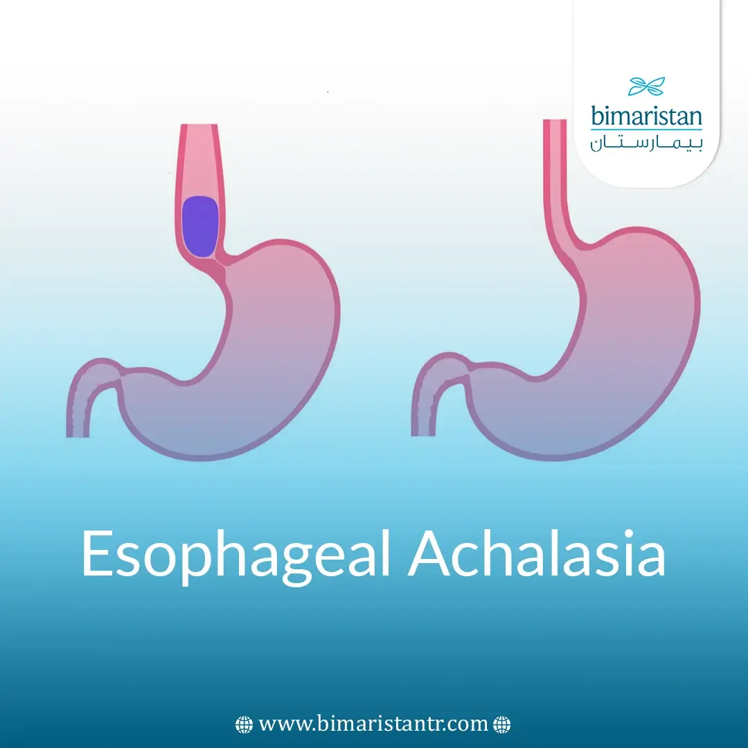 Achalasia Treatment