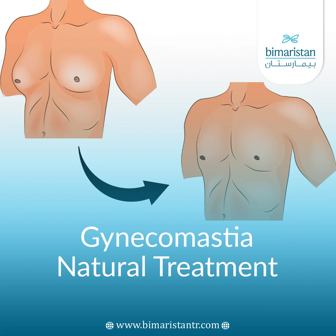 Gynecomastia Natural Treatment