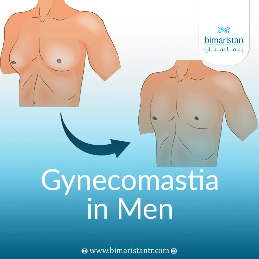 Gynecomastia In Men