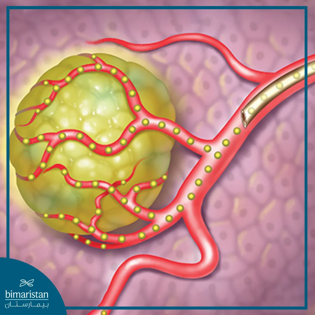 Radiocoagulation Used In Radiotherapy In Turkey 