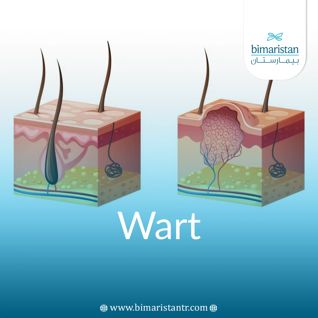 Wart