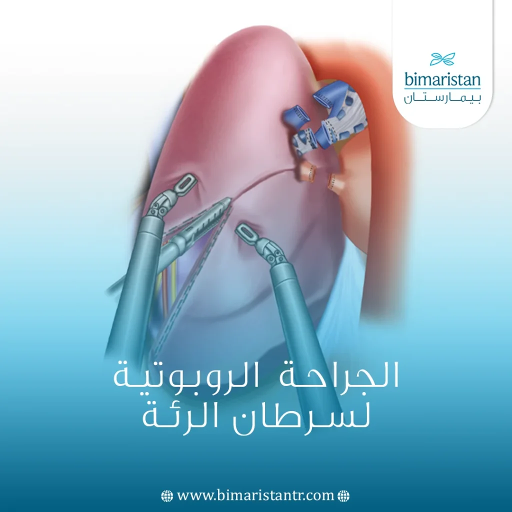 الجراحة الروبوتية لسرطان الرئة في تركيا