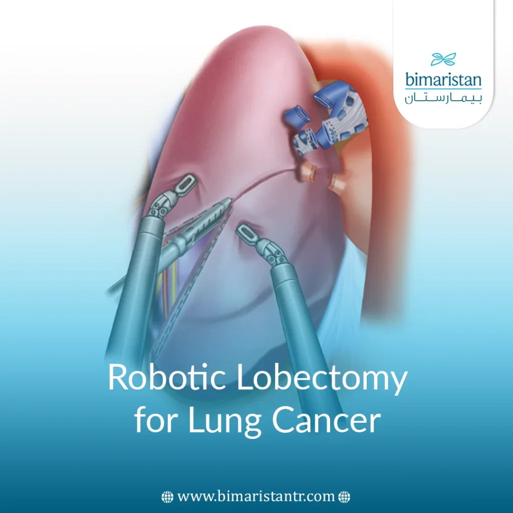 Robotic Lobectomy For Lung Cancer