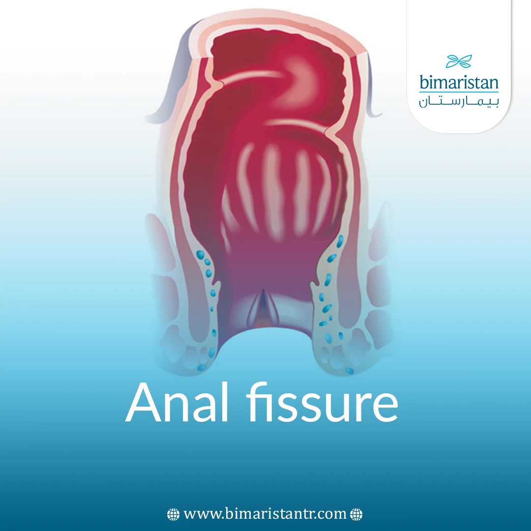 Anal Fissure Main Causes And Treatment Methods Bimaristan