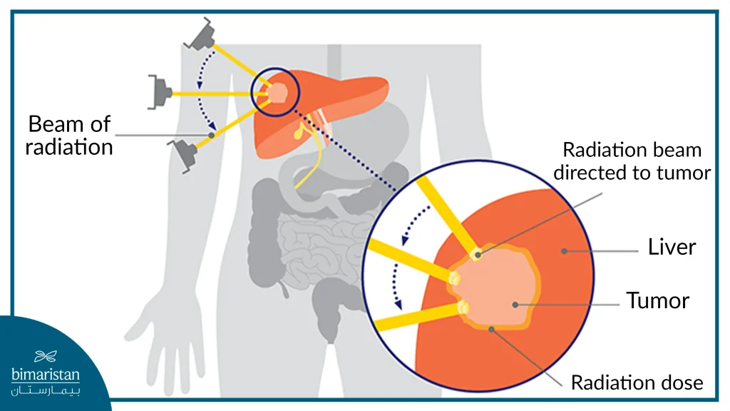 External Beam Radiation Therapy