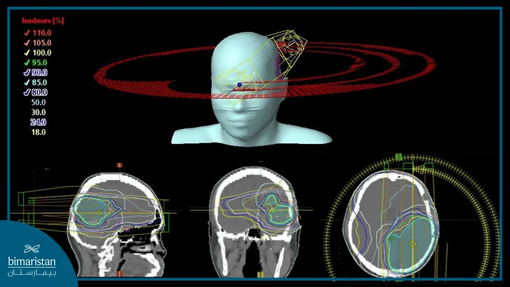 Volumetric Modulated Arc Therapy (Vmat)