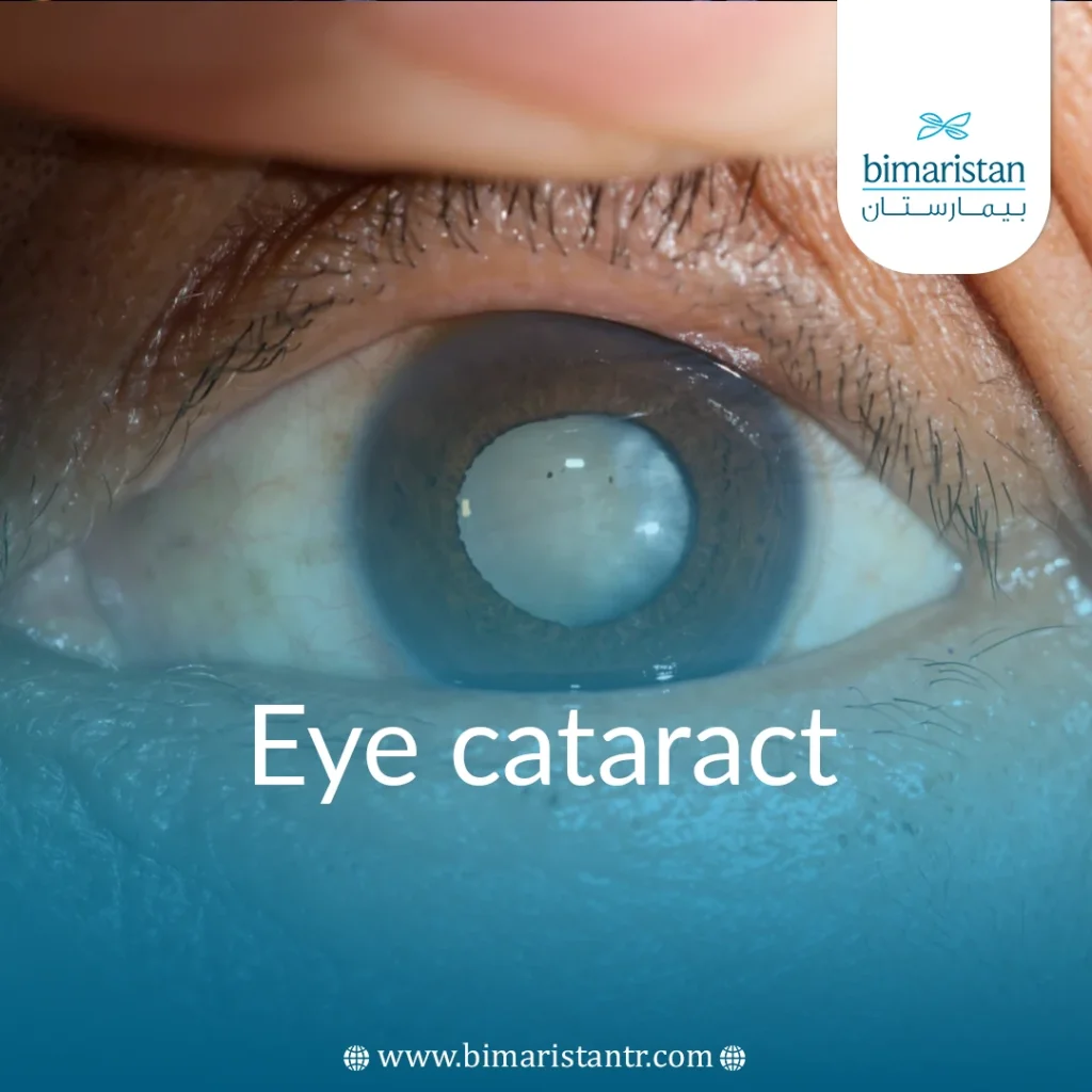 Eye Cataract