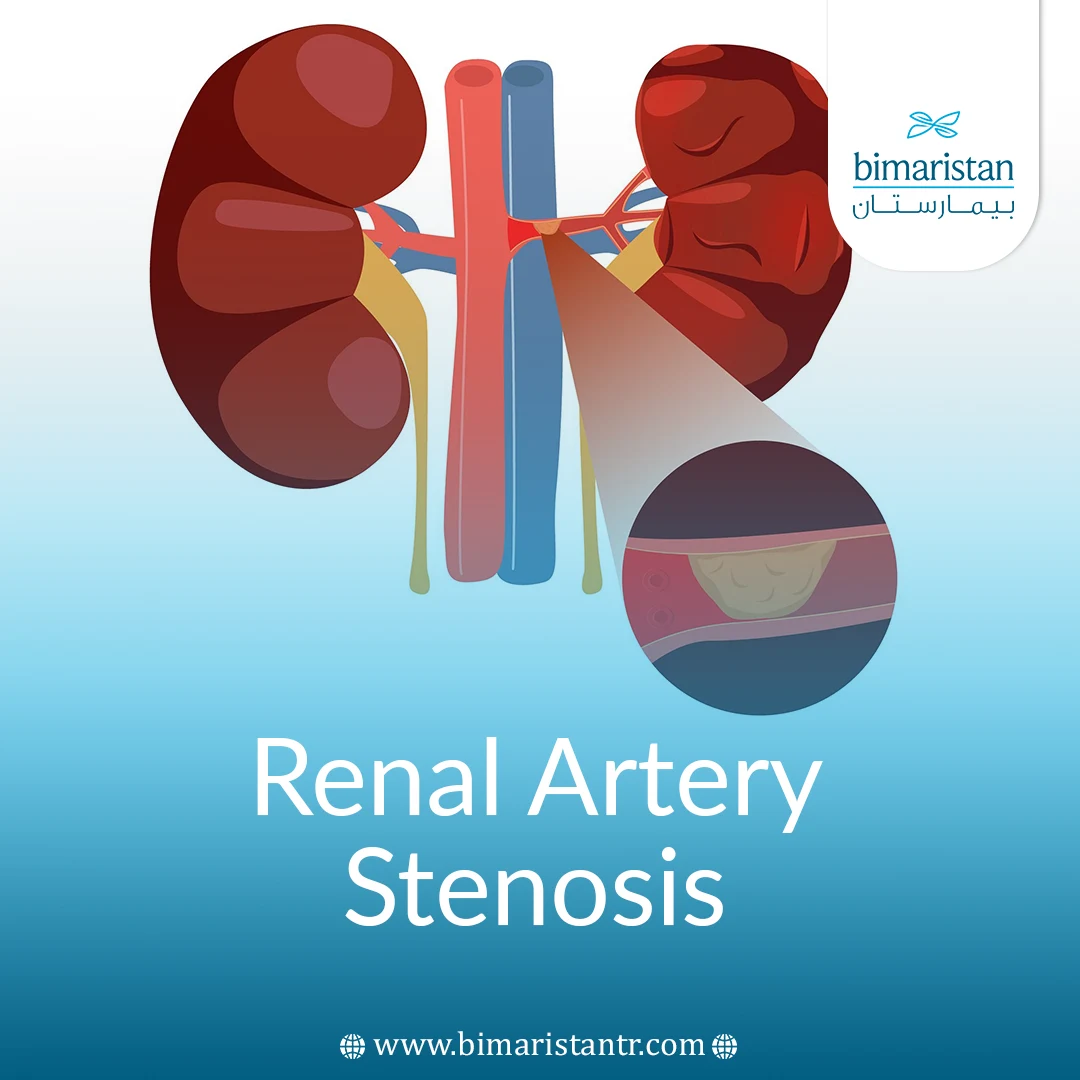 Renal Artery Stenosis: Symptoms And Treatment In Turkey