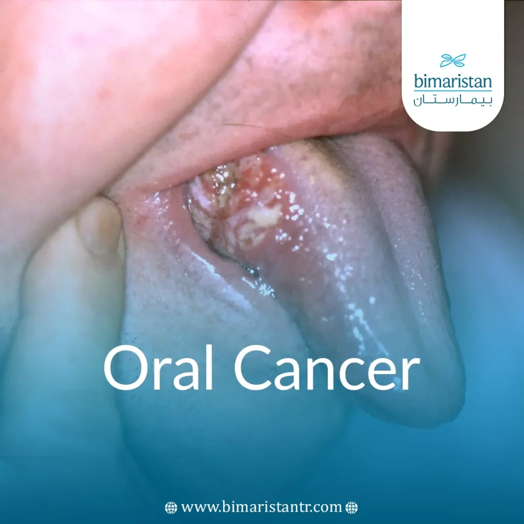 Oral Cancer Treatment In Turkey