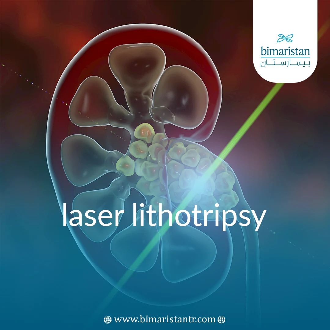 Laser Lithotripsy In Turkey