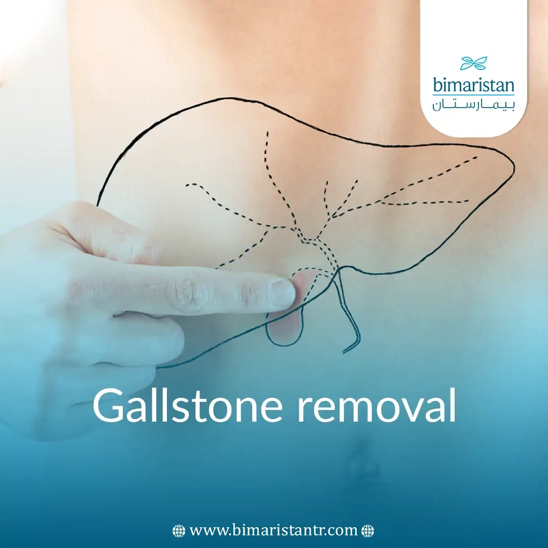 Gallstone Removal