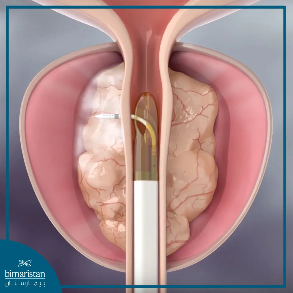 Rezūm Technique For Bph Treatment With Water Vapor