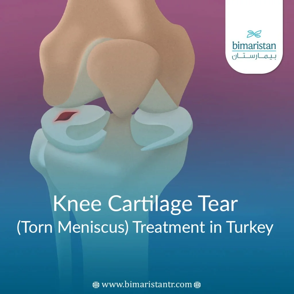 Knee Cartilage Tear Treatment In Turkey