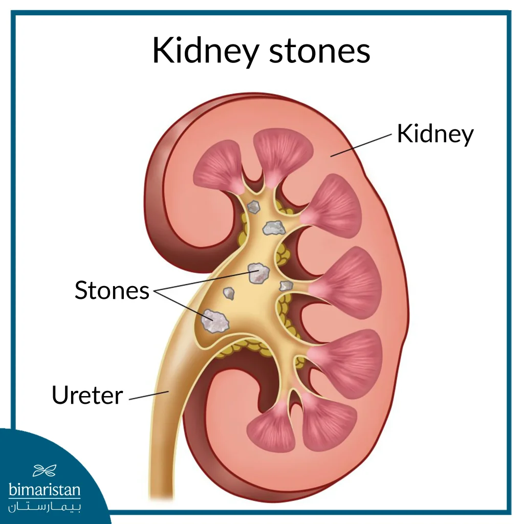 Kidney Stones