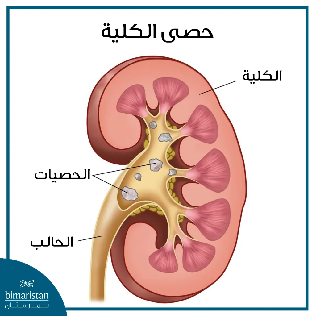 حصى الكلى