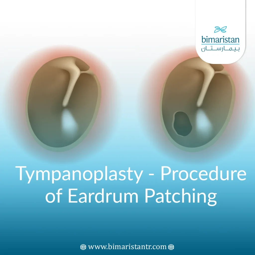 Tympanoplasty - Procedure Of Eardrum Patching