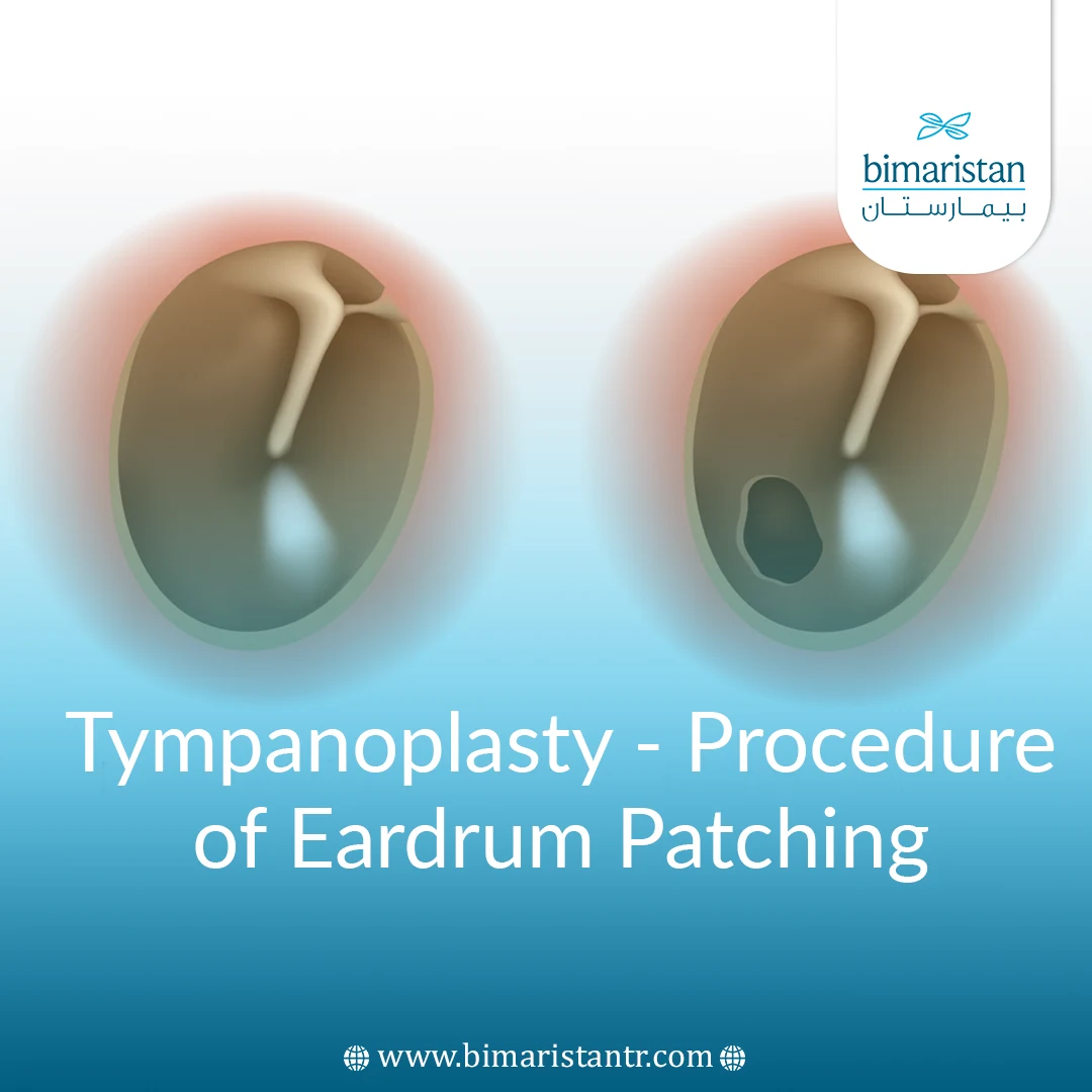 Tympanoplasty - Procedure Of Eardrum Patching