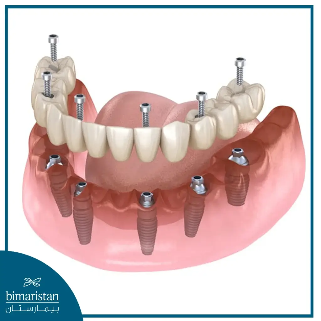 All-On-6 Dental Implants In Dentistry Centers In Turkey