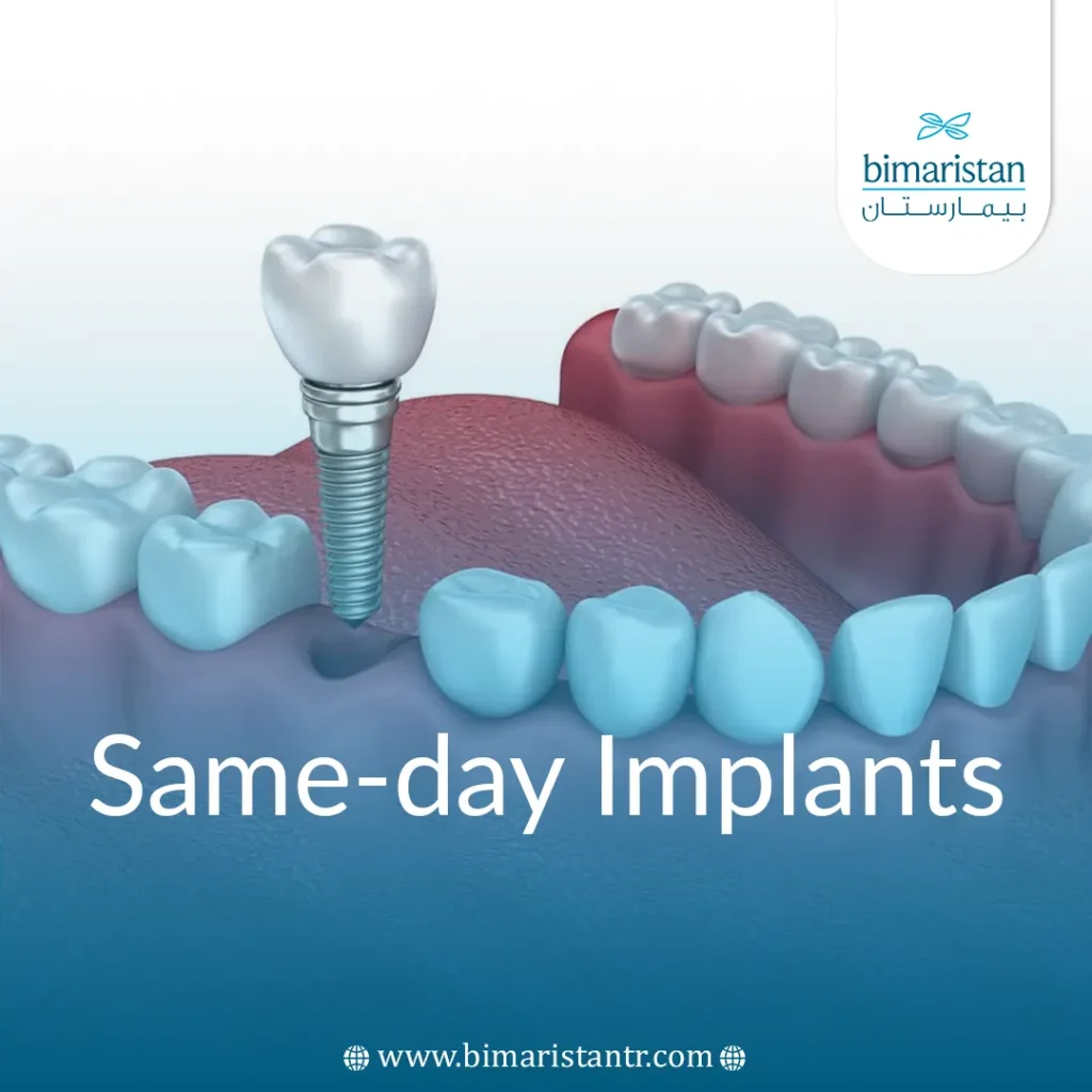 Same-Day Implants