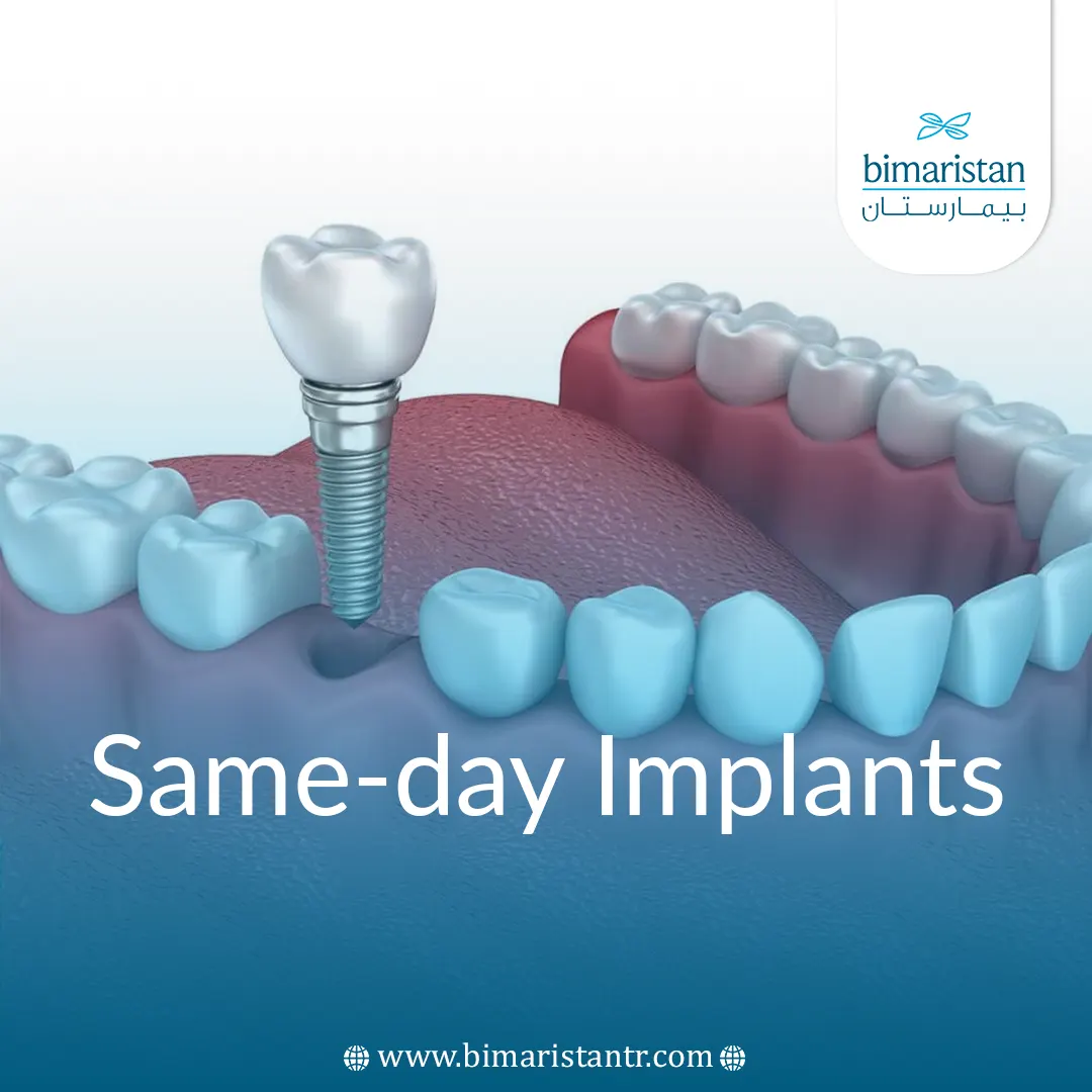 Same-Day Implants