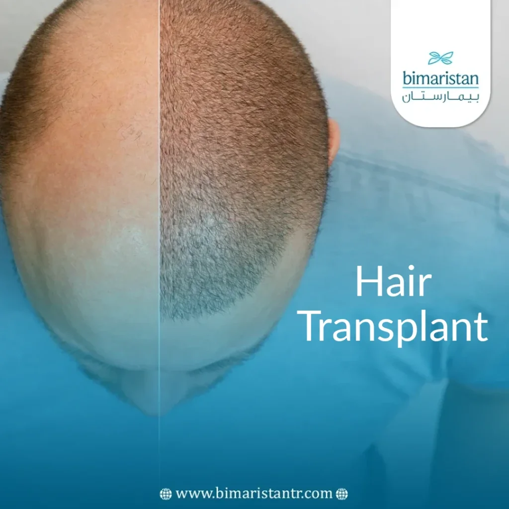 Hair Transplant In Turkey