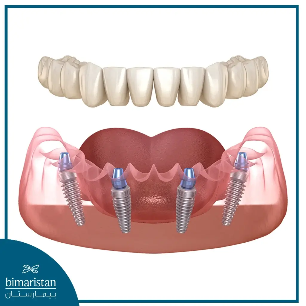 All-On-4 Dental Implants In Dentistry Centers In Turkey