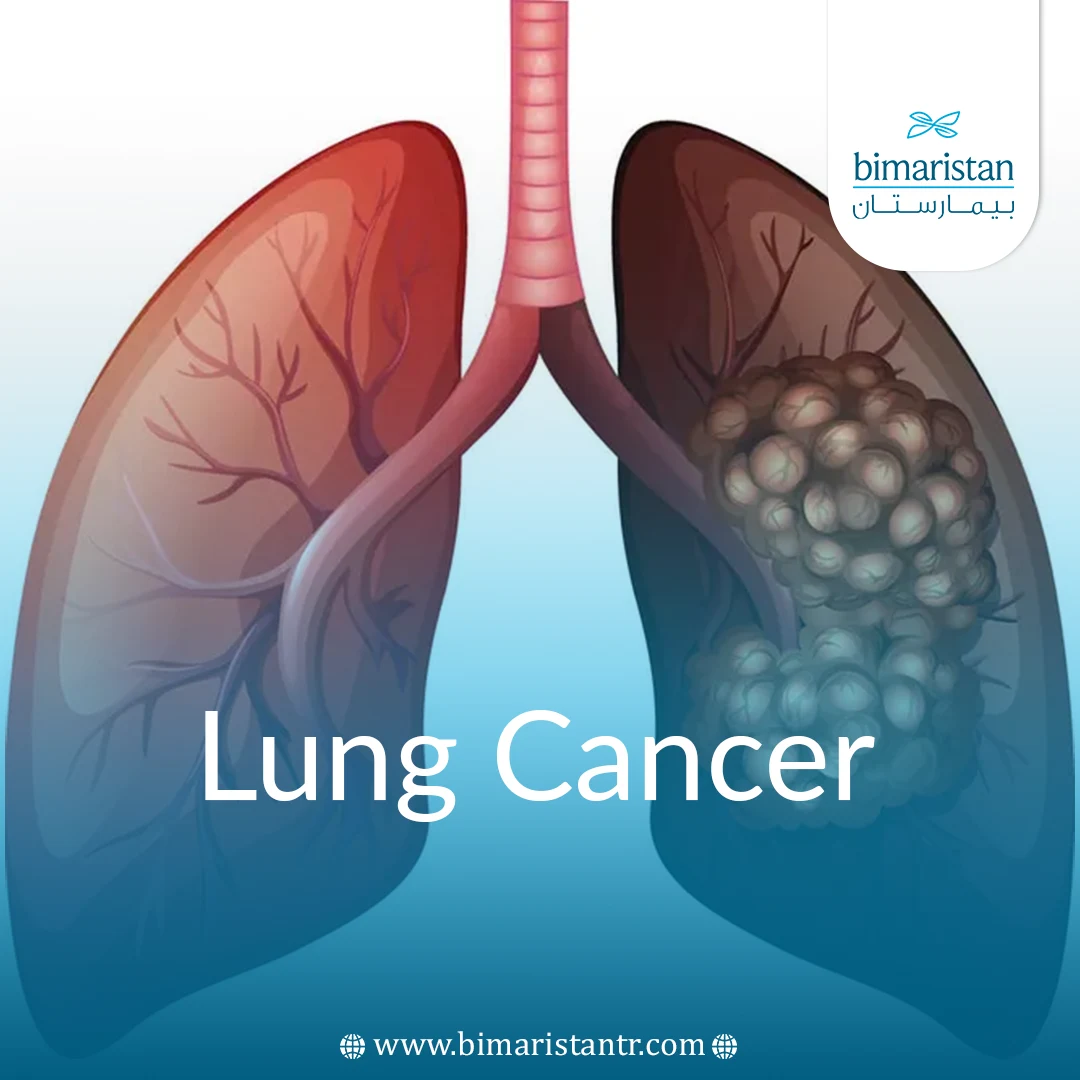 Lung Cancer