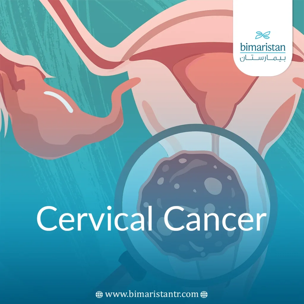 Causes, Symptoms And Treatment Methods For Cervical Cancer In Turkey