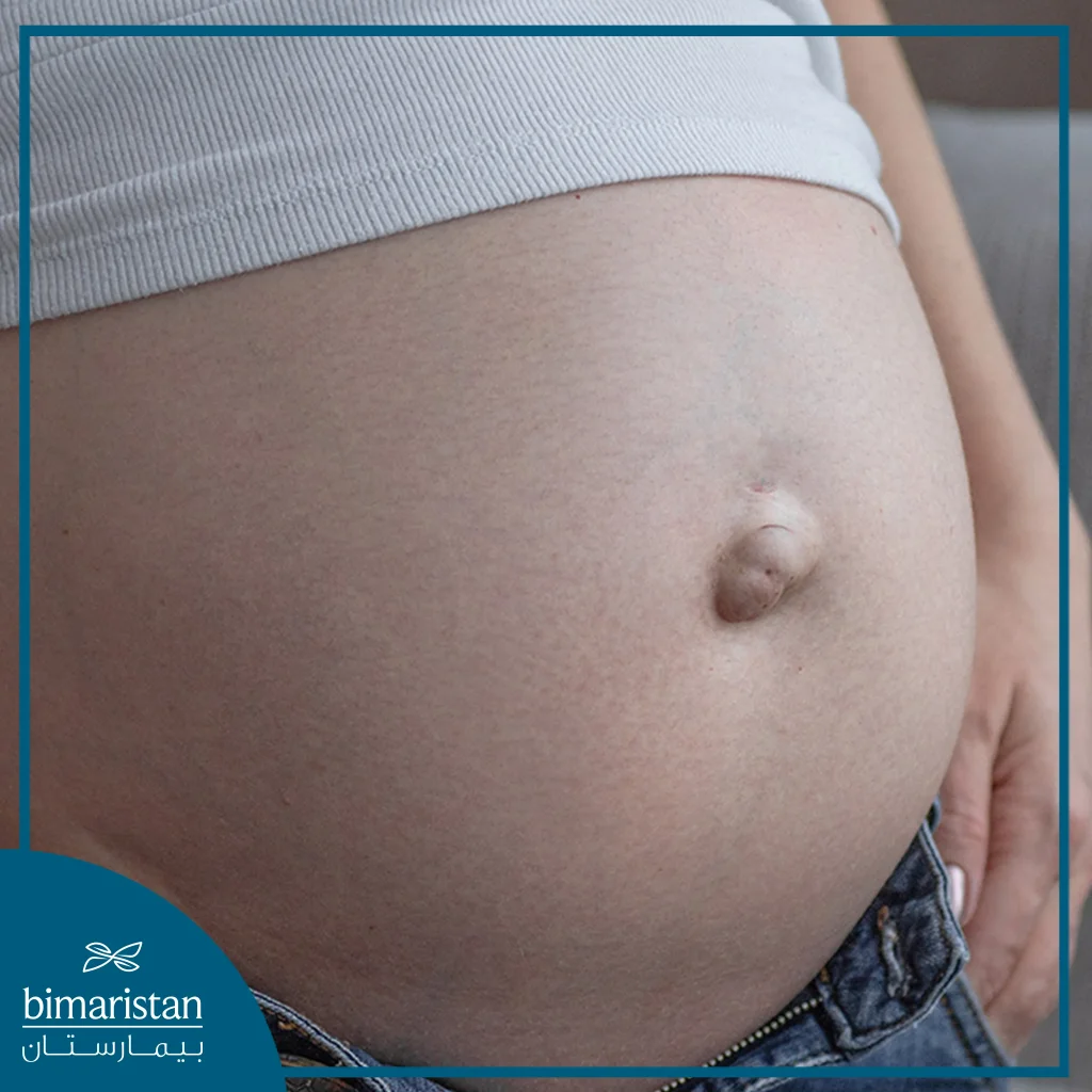 Can An Umbilical Hernia Cause Weight Gain Umbilical Hernia in Women | Cause and Treatment - Bimaristan