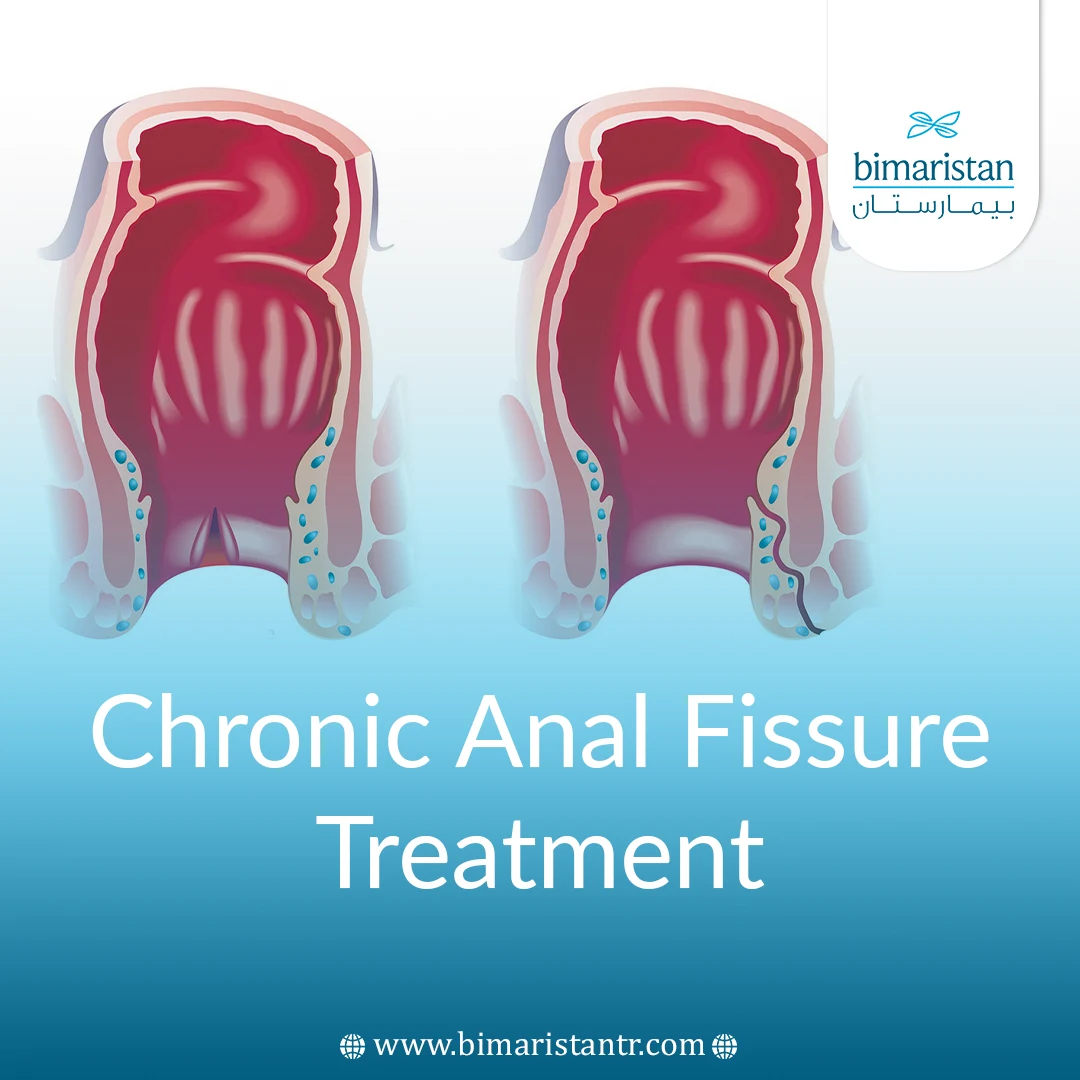 Chronic ِAnal Fissure Treatment