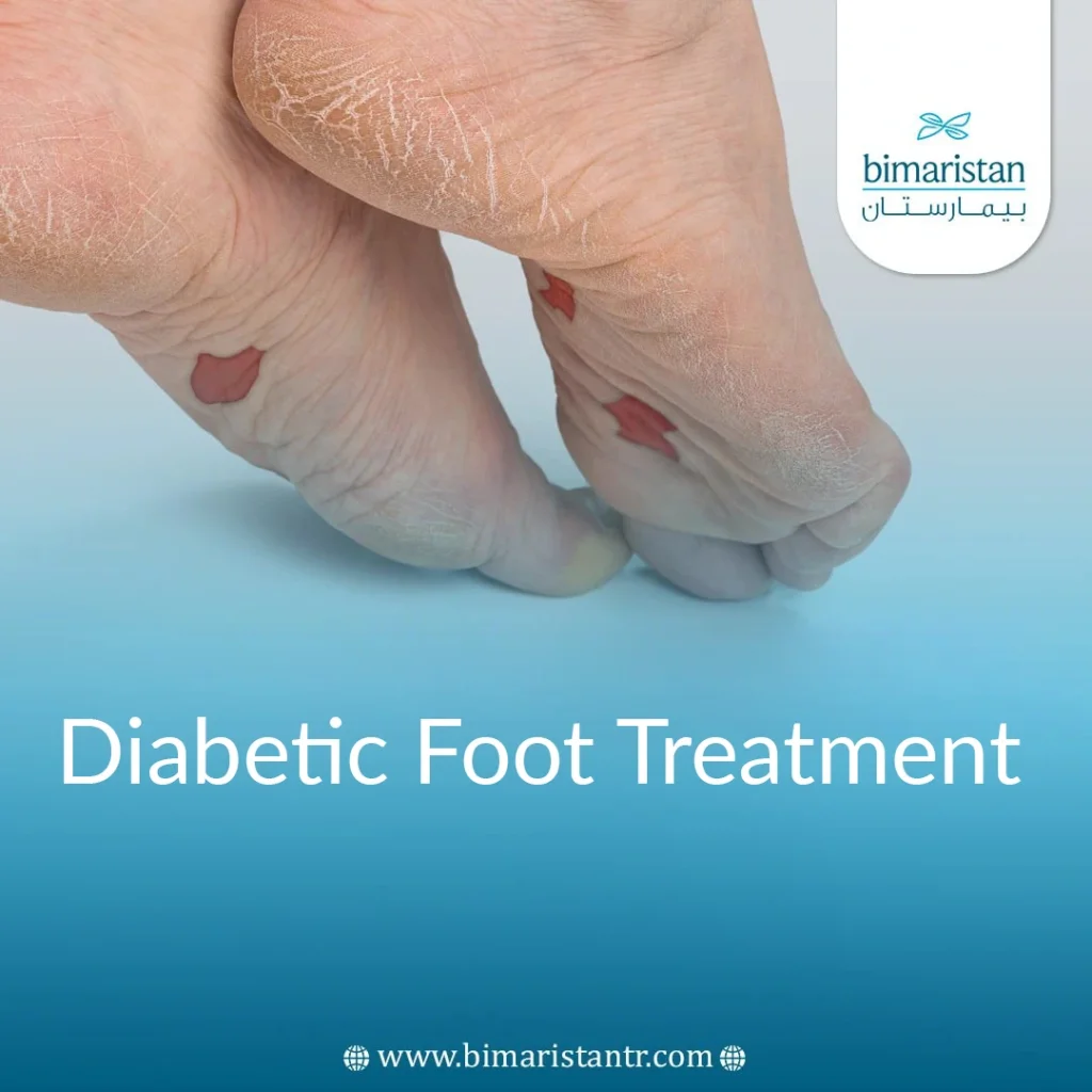 Endovascular Treatment Of Diabetic Foot