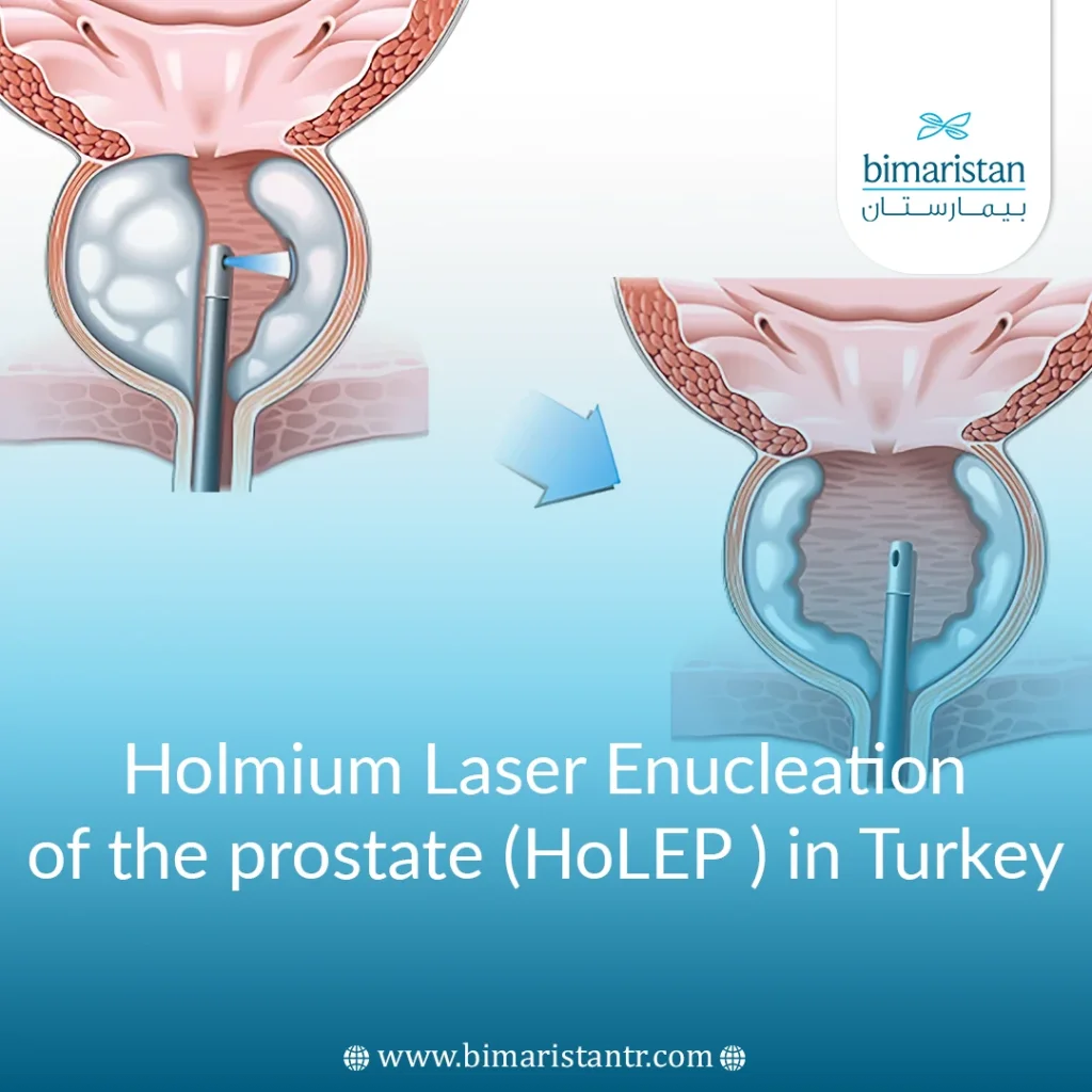 Holmium Laser Enucleation Of The Prostate