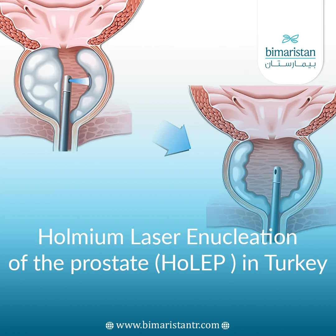 Holmium Laser Enucleation Of The Prostate